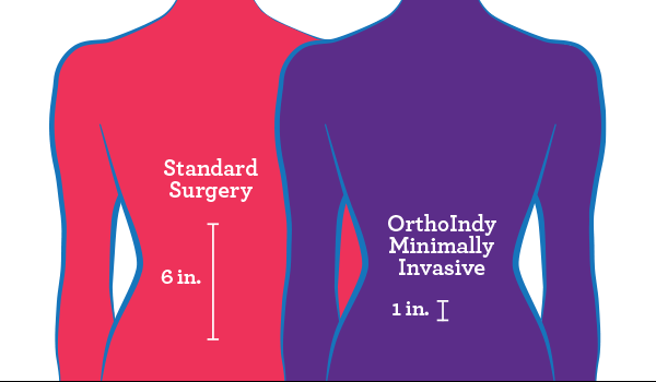 Minimally Invasive Spine Surgery Incision